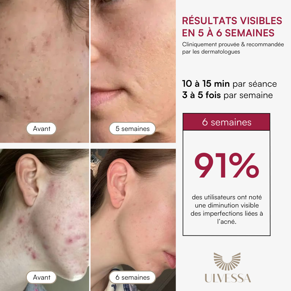 Masque LED Visage Luminothérapie - ULVESSA Série 2