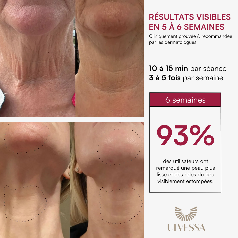 Masque LED Visage Luminothérapie - ULVESSA Série 2