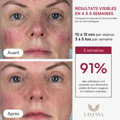 Masque LED Visage Luminothérapie - ULVESSA Série 2