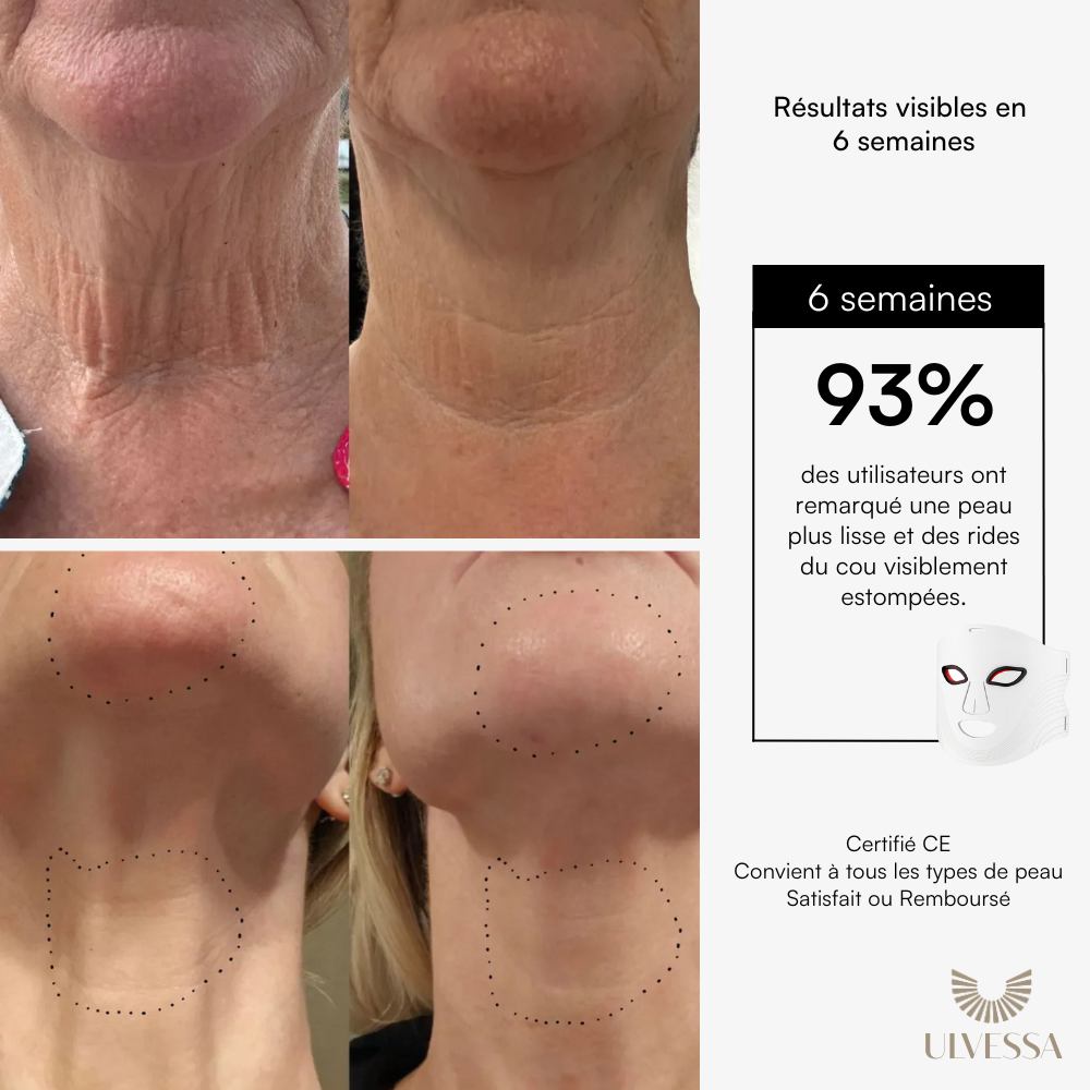 Masque LED Visage Luminothérapie - ULVESSA Série 2