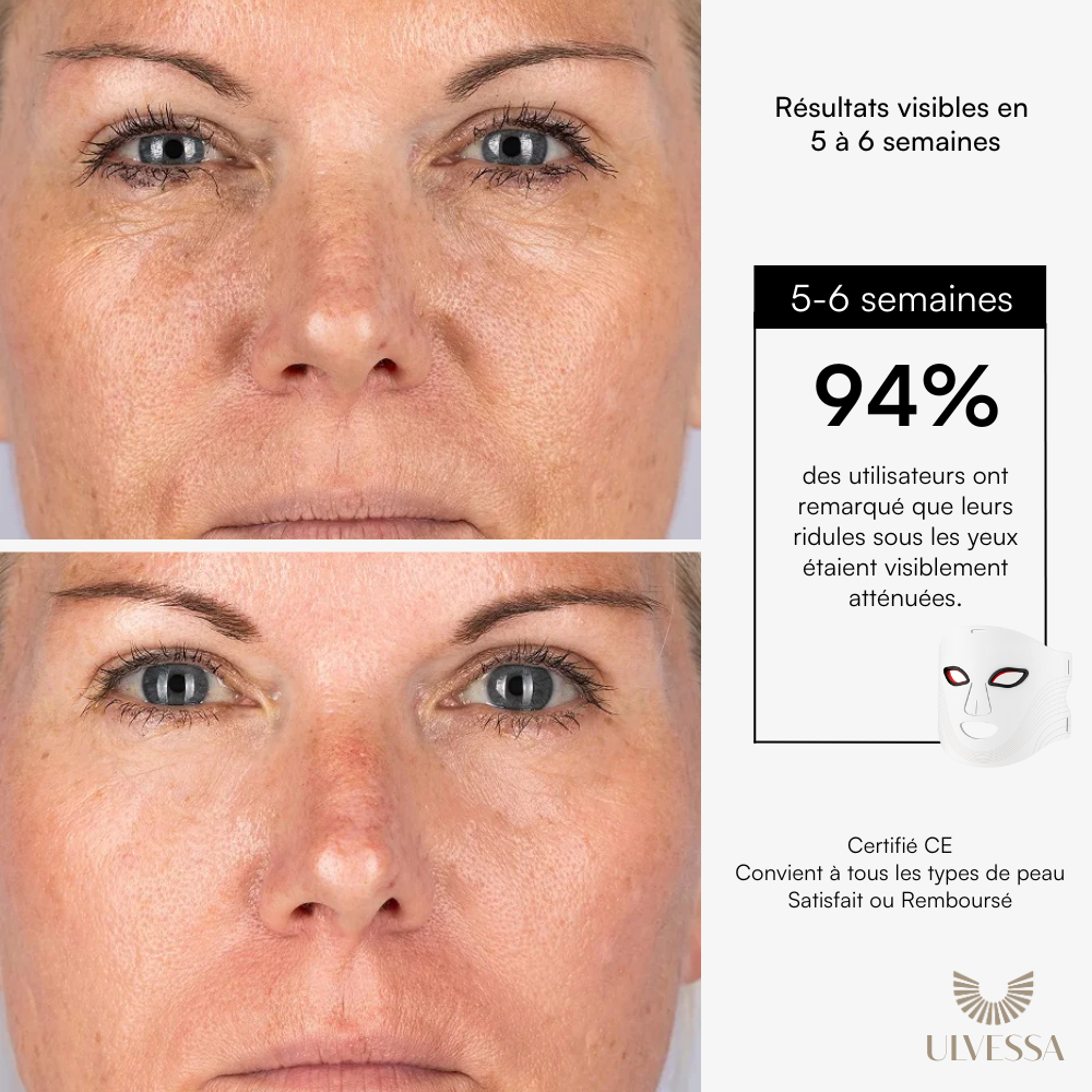 Masque LED Visage Luminothérapie - ULVESSA Série 2