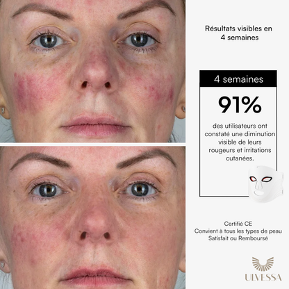 Masque LED Visage Luminothérapie - ULVESSA Série 2